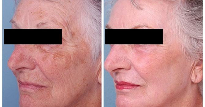 Erbium Yag / Skin Resurfacing