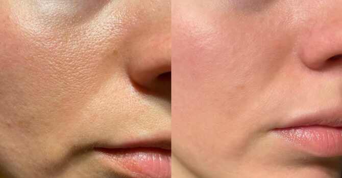 Microneedling: A Clinically-Proven Approach to Skin Renewal image