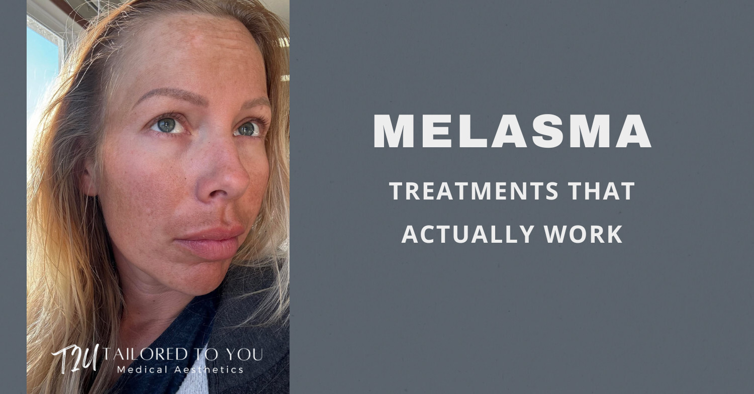 Melasma and treatments that actually work in Mitchell south Dakota 
