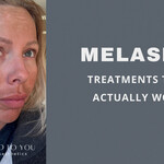 Melasma and treatments that actually work in Mitchell south Dakota 