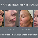 Melasma causes and treatments that actually work 