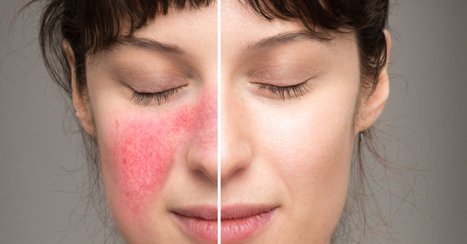 IPL "Intense Pulse Light" Non-ablative procedures