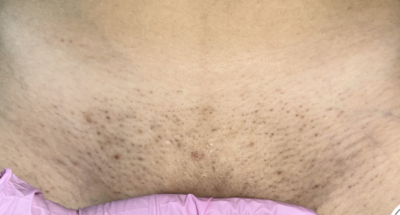 hair removal_bikini line hair_waxing near me_hair removal near me_tailored to you 