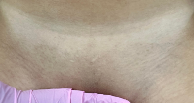 hair removal_bikini line hair_waxing near me_hair removal near me_tailored to you 