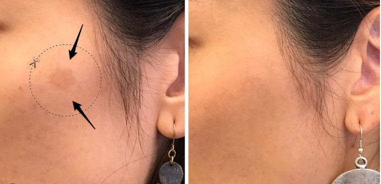 targeting sun spots_removing sunspots