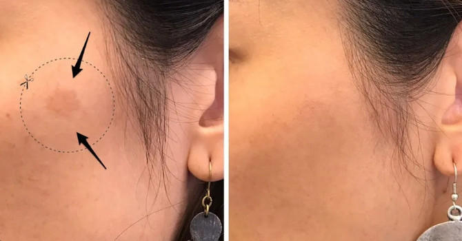 Pico Laser Facial Rejuvenation: The No-Downtime Treatment for Sunspots, Uneven Skin Tone & Texture