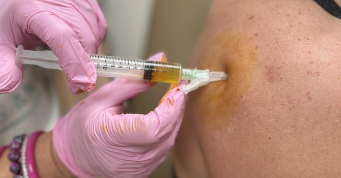 PRP Therapy for Pain: A Long-Term, Natural Alternative to Steroid Injections