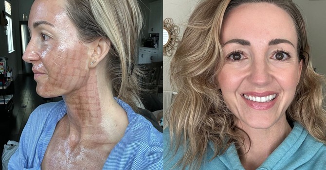 Phoenix CO2 Laser Face, Neck & Hands