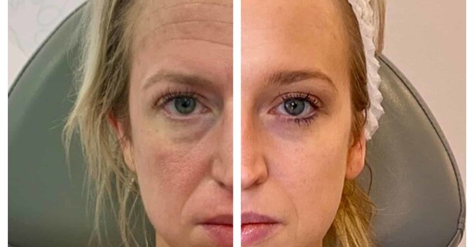 Collagen Restoration & Thread Lifting