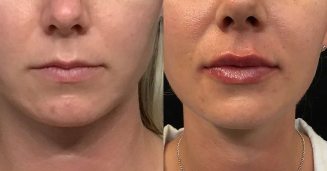 Lip Filler: What It Really Is, What to Expect, and How We Approach It